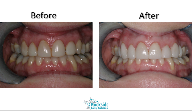 Get the Smile You Want with Veneers