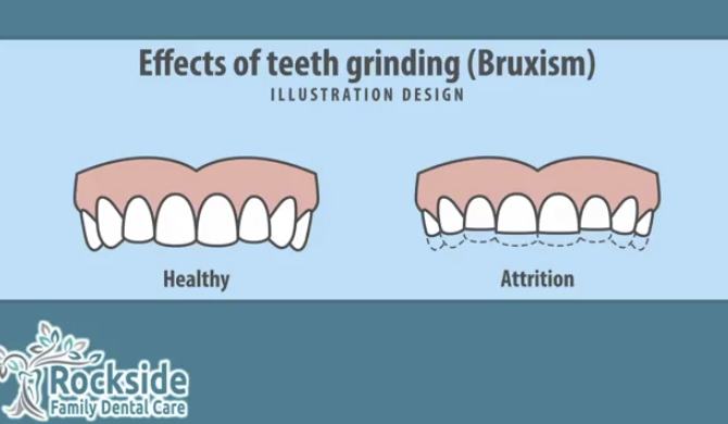 Are You Grinding Your Teeth Because of Stress?