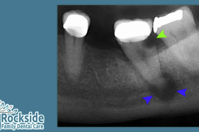 Crown and Fillings FAQ