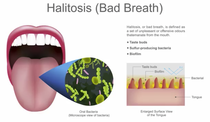 Why do I Have Bad Breath?