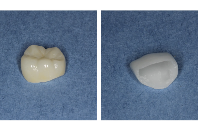 The Benefits of Zirconia Crowns